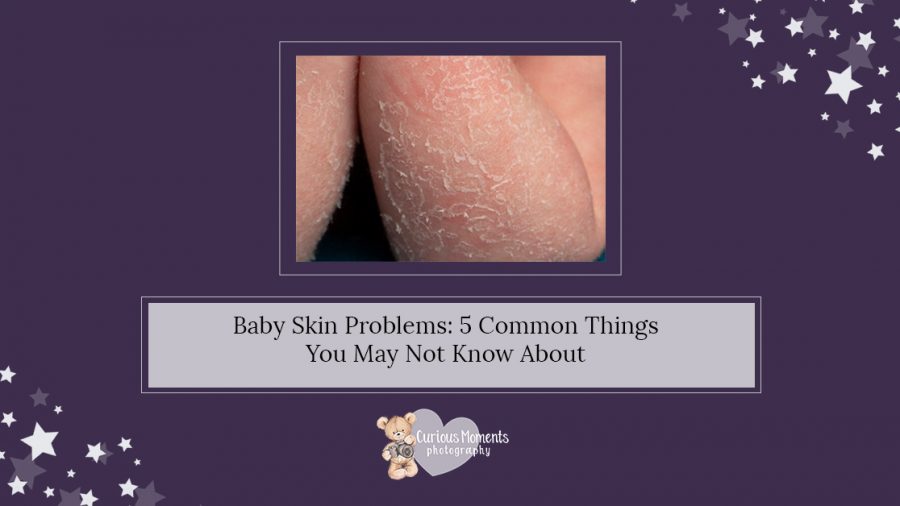 Baby Skin Problems: 5 Common Things You May Not Know About